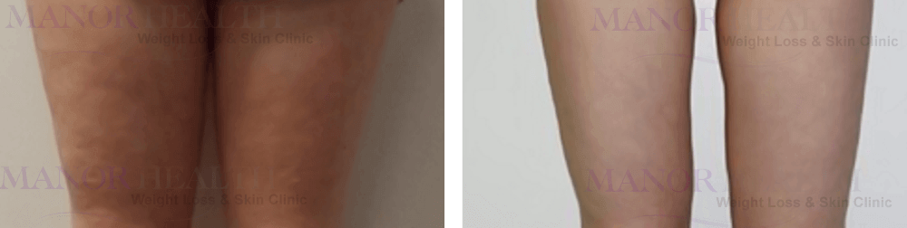 before after ultrasound weight loss by Manor Health Leeds Horsforth