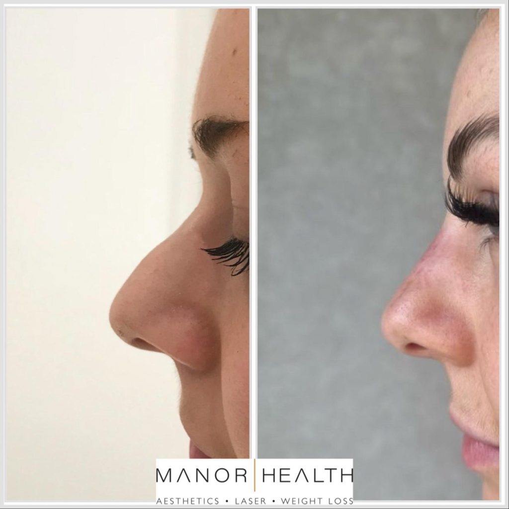 nose augmentation before and after picture