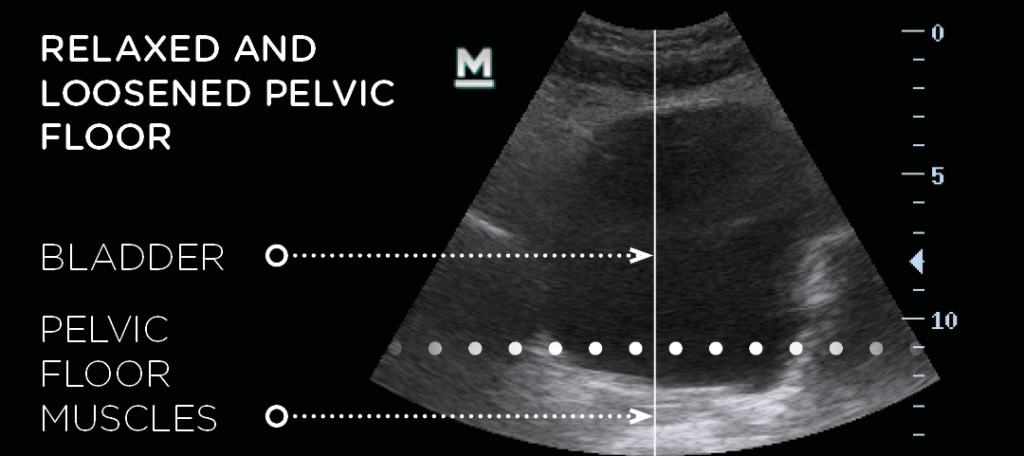 Ultrasound scan showing loose pelvic floor muscles before emsella treatment