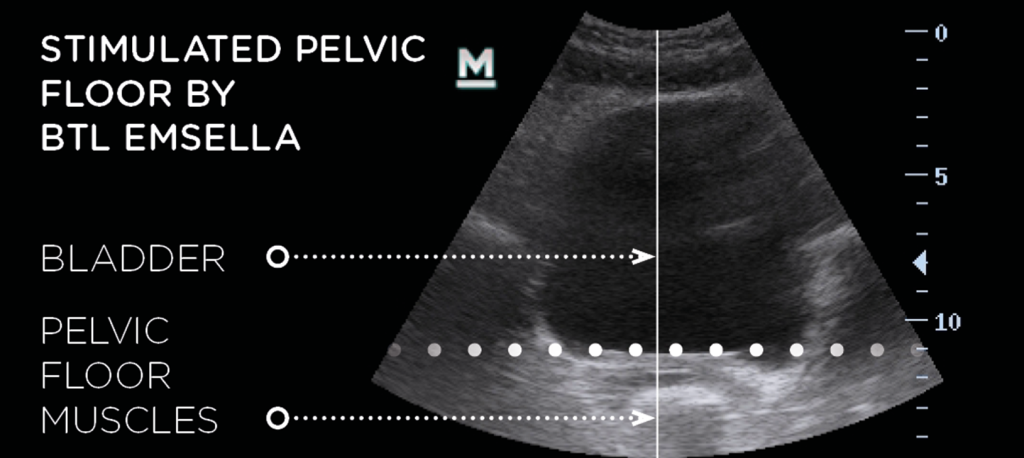 Ultrasound scan showing stimulated pelvic floor muscles after having the emsella treatment