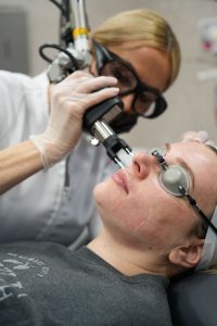 person having co2 laser treatment on face