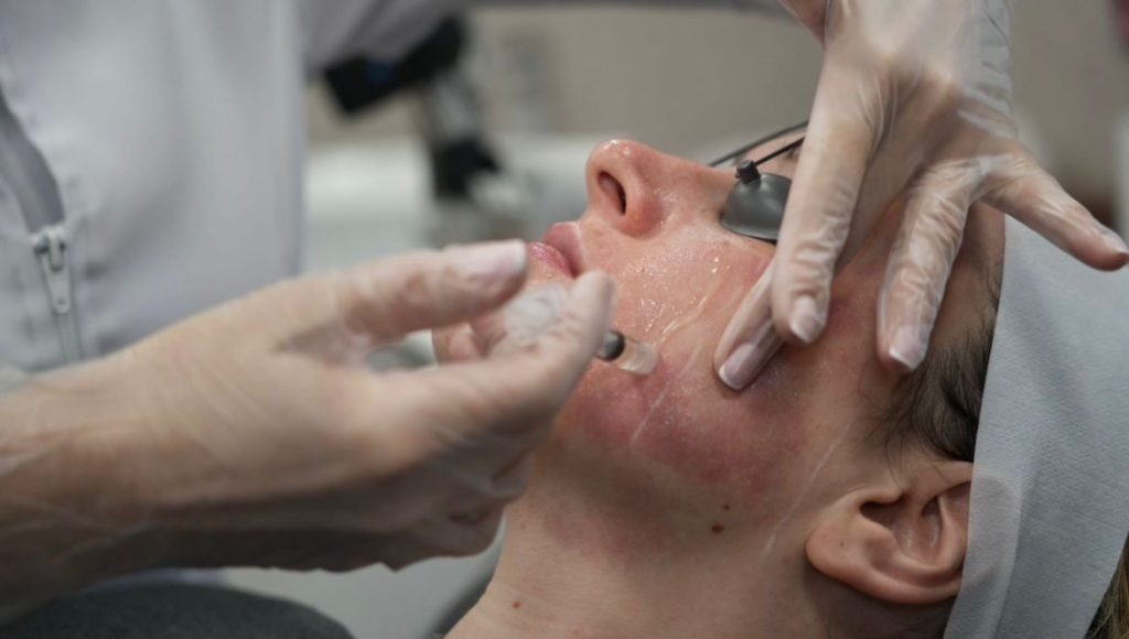 person having exosomes treatment with co2 laser