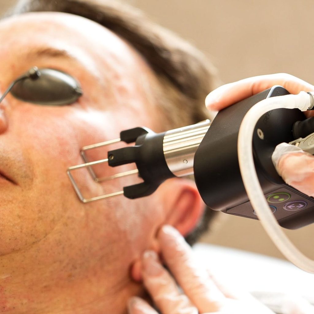 co2 laser facial treatment