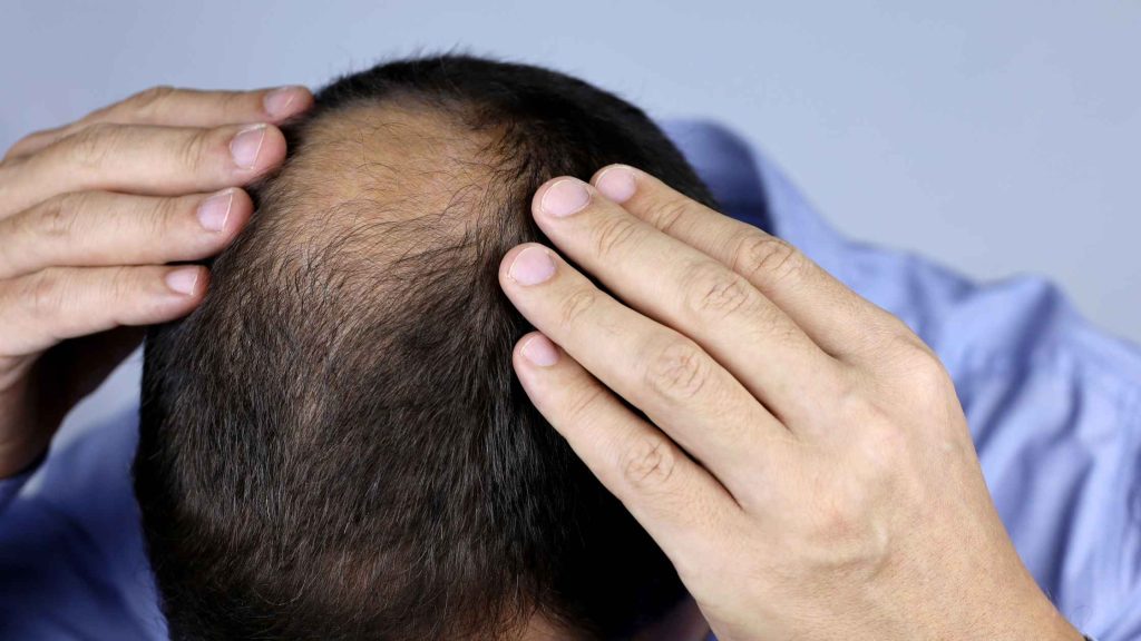 hair loss treatment