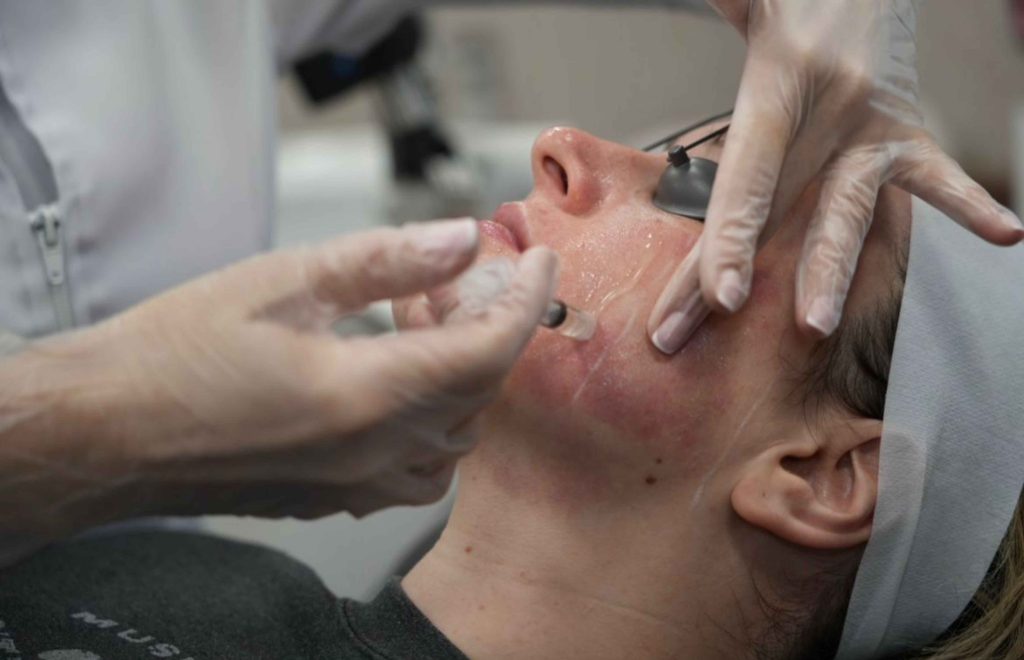 lady getting exosomes treatment on face